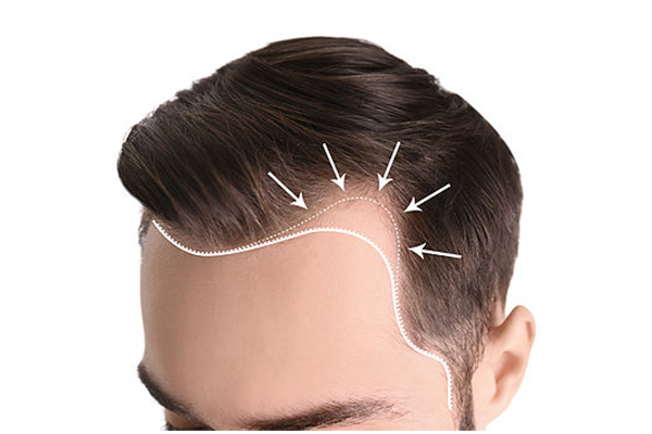 Trassiz Sac Ekimi Hakkinda Tum Bilmeniz Gerekenler Forever Hair Transplant