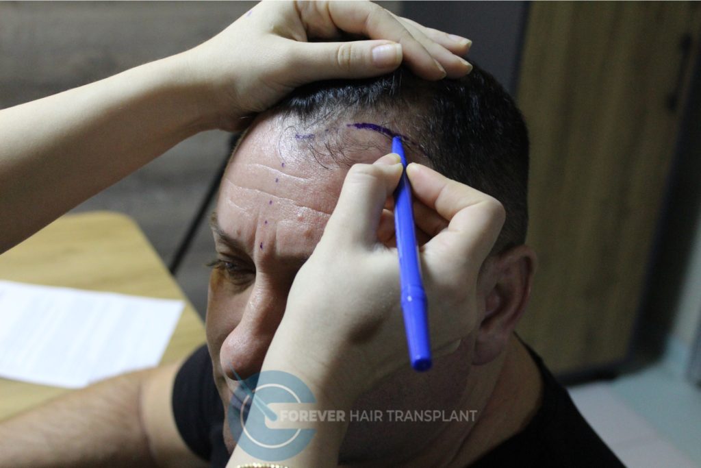 Forever Hair Transplant