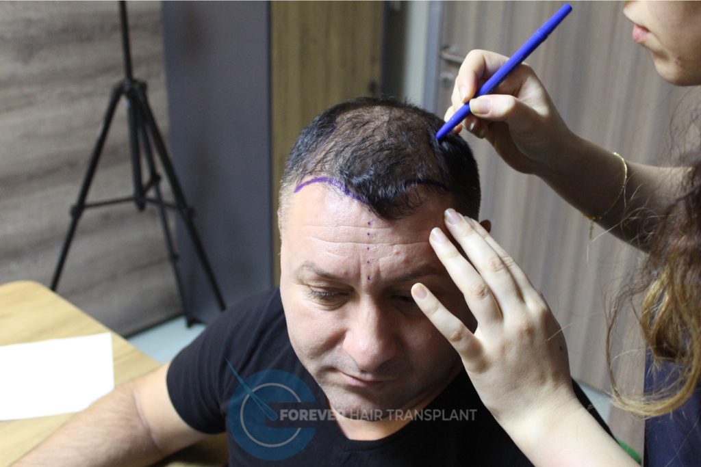 Forever Hair Transplant