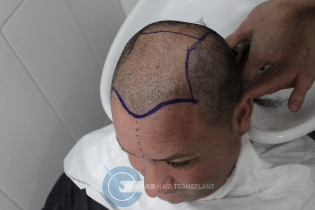 Forever Hair Transplant