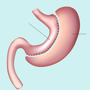 Gastric sleeve