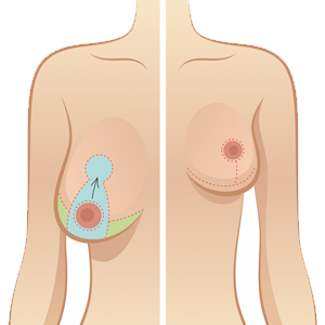 breast reduction