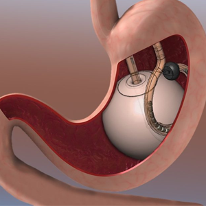 GASTRIC BALLOON