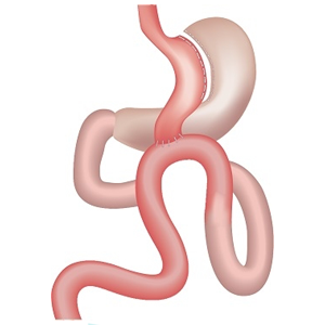 GASTRIC BYPASS