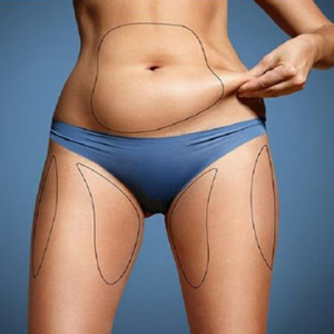 liposuction